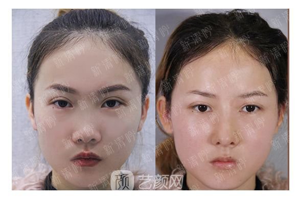 耳軟骨綜合隆鼻半個月了，分享恢復果照片~