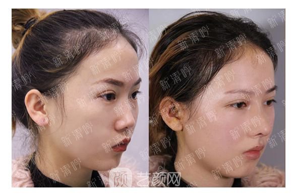 耳軟骨綜合隆鼻半個月了，分享恢復果照片~