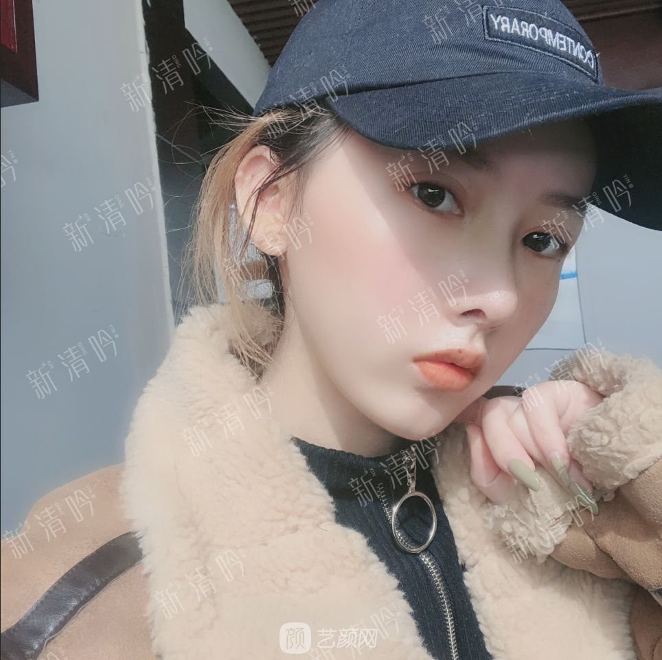 耳軟骨綜合隆鼻半個月了，分享恢復果照片~