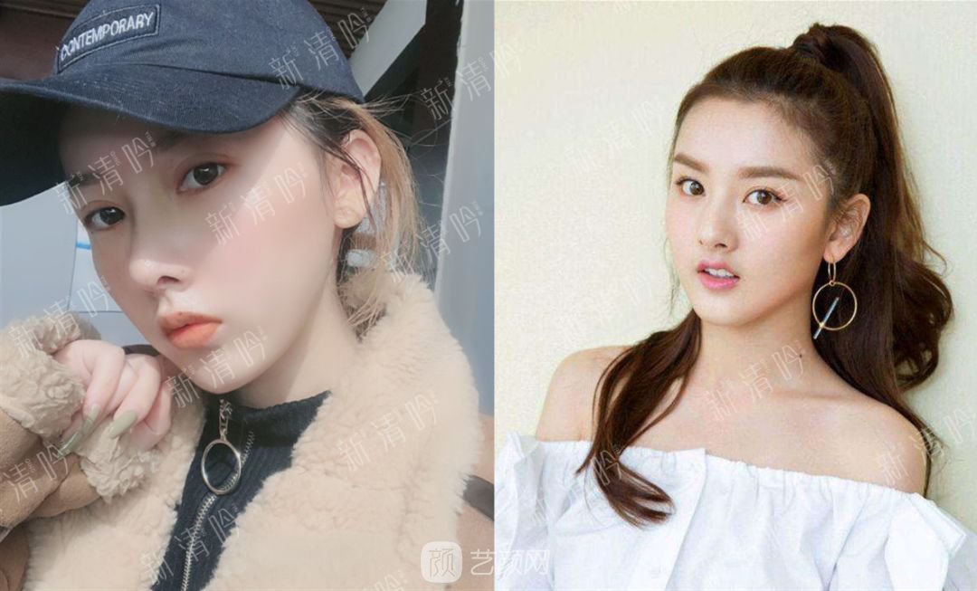 耳軟骨綜合隆鼻半個月了，分享恢復果照片~