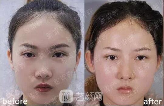 耳軟骨隆鼻果怎么樣？案例照片一覽~