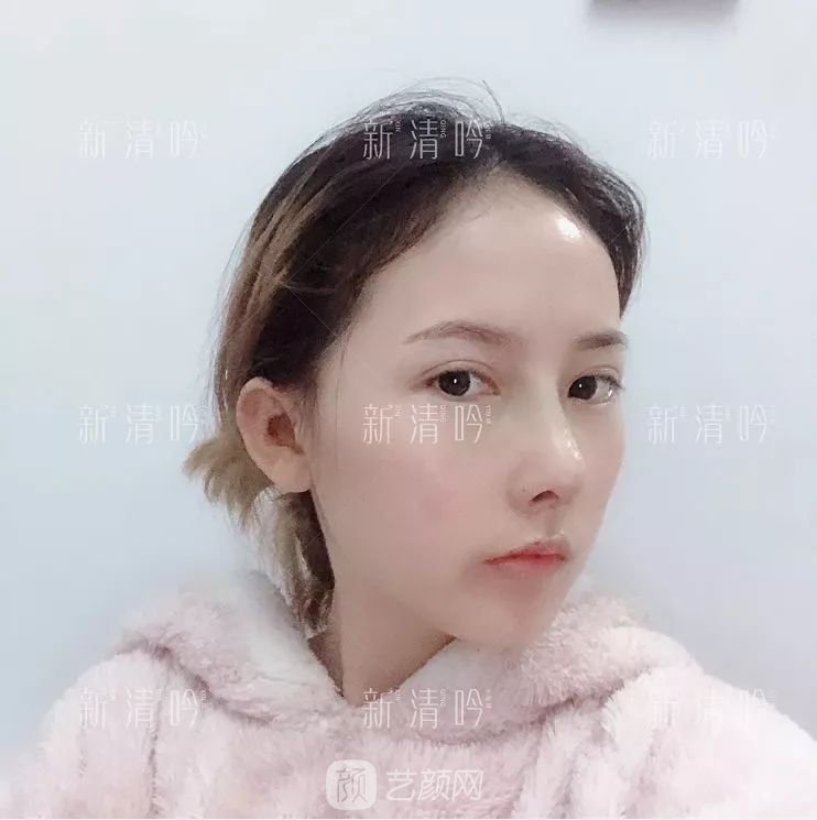 耳軟骨隆鼻果怎么樣？案例照片一覽~