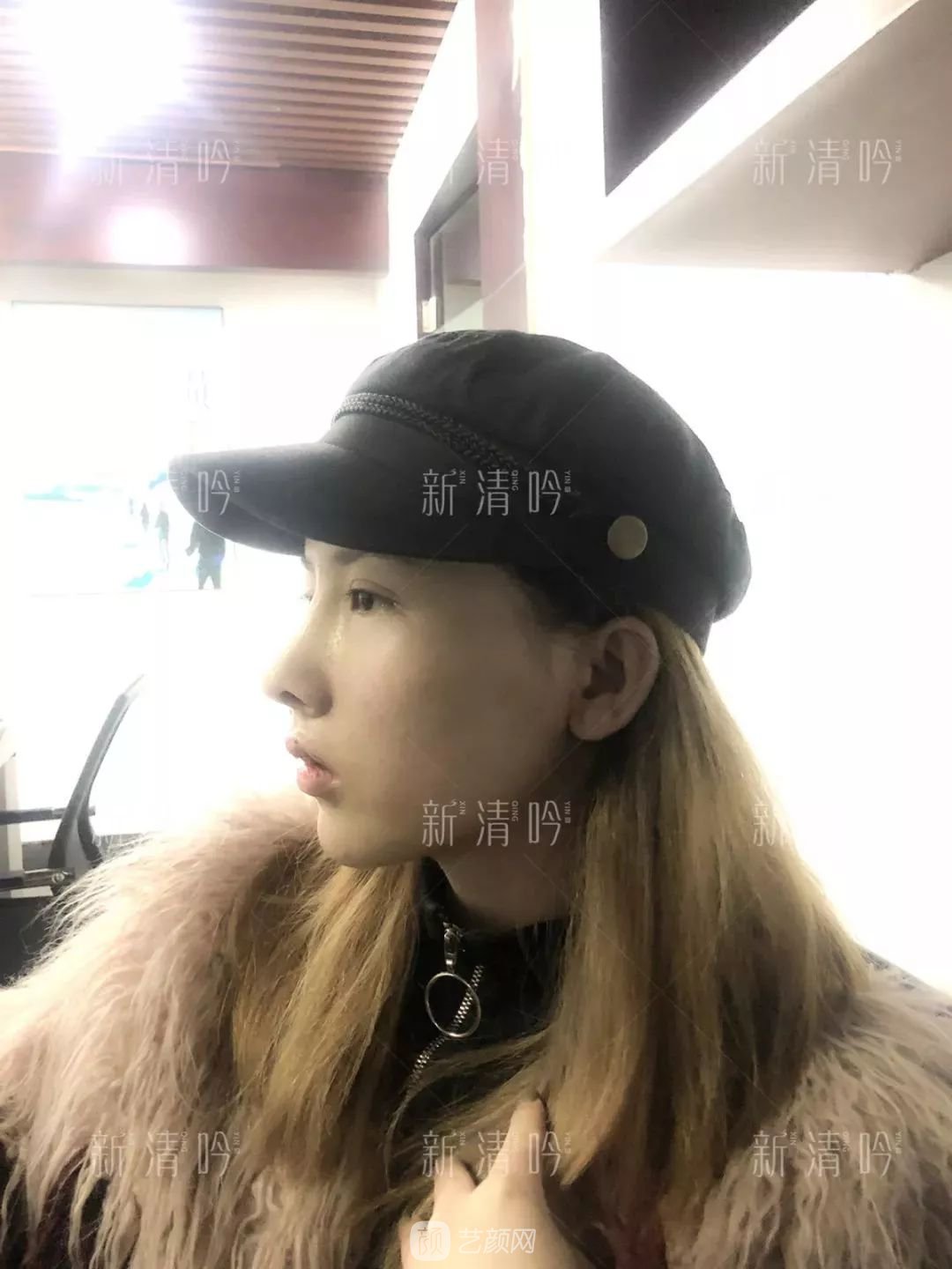 耳軟骨隆鼻果怎么樣？案例照片一覽~