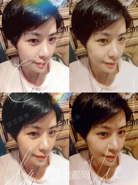 自體肋軟骨隆鼻+假體隆下頜一個(gè)月果照片分享~