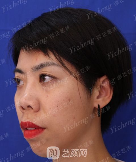 自體肋軟骨隆鼻+假體隆下頜一個(gè)月果照片分享~