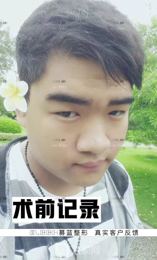 眼部手術(shù)案例——昆明募藍(lán)術(shù)后一年果照片分享~