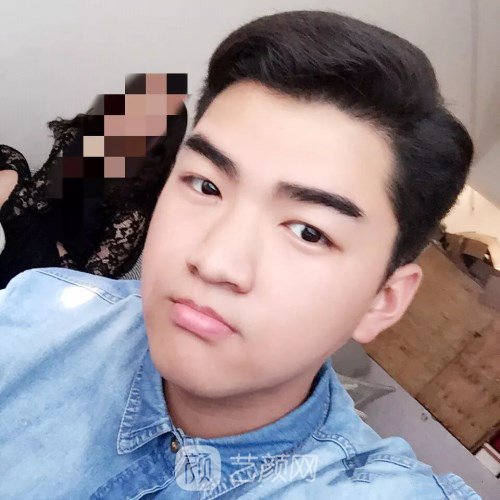 眼部手術(shù)案例——昆明募藍(lán)術(shù)后一年果照片分享~