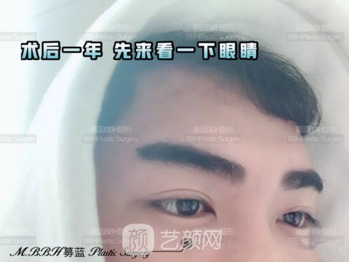 眼部手術(shù)案例——昆明募藍(lán)術(shù)后一年果照片分享~
