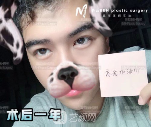 眼部手術(shù)案例——昆明募藍(lán)術(shù)后一年果照片分享~