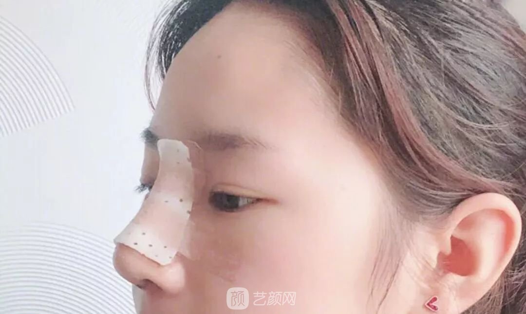 鼻部手術(shù)一個(gè)月恢復(fù)日記分享~