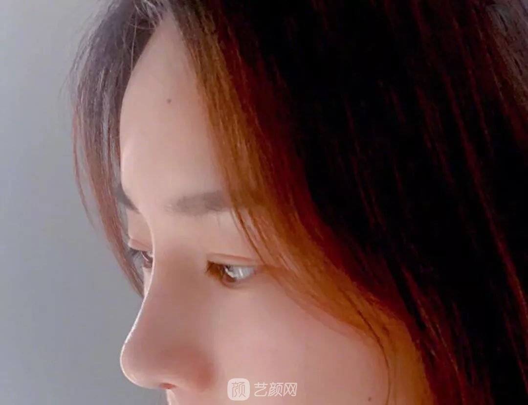 鼻部手術(shù)一個(gè)月恢復(fù)日記分享~