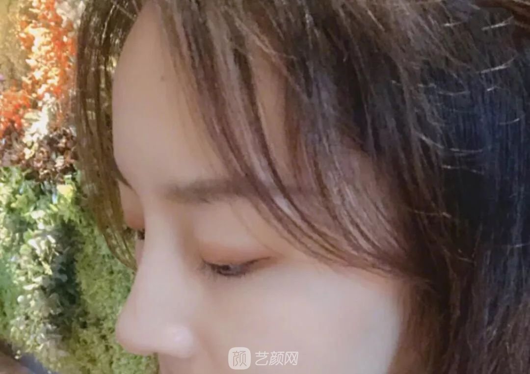 鼻部手術(shù)一個(gè)月恢復(fù)日記分享~