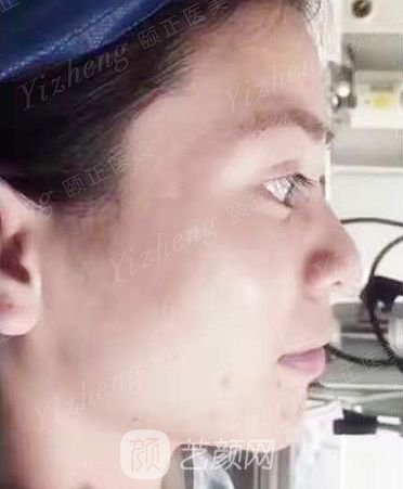 葫蘆島頤正夏秉成鼻部手術(shù)+SVF自體脂肪多方面部填充案例~