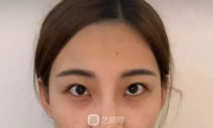 眼部手術(shù)一個(gè)月恢復(fù)日記，片分享~