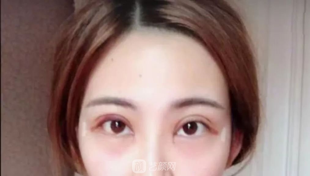 眼部手術(shù)一個(gè)月恢復(fù)日記，片分享~