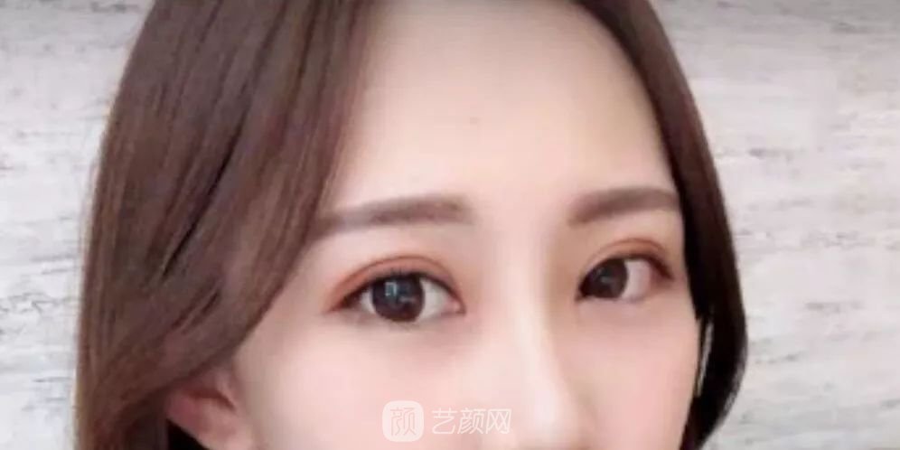 眼部手術(shù)一個(gè)月恢復(fù)日記，片分享~