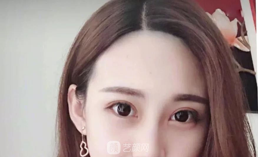 眼部手術(shù)一個(gè)月恢復(fù)日記，片分享~