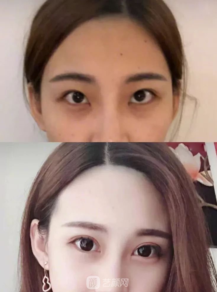 眼部手術(shù)一個(gè)月恢復(fù)日記，片分享~