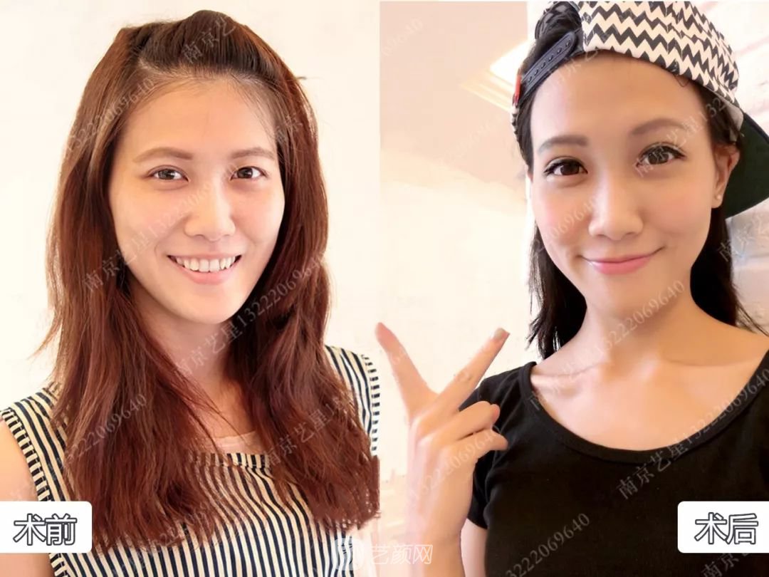 Yestar美杜莎美眼術一周案例圖片，芭比雙眼皮果很好~