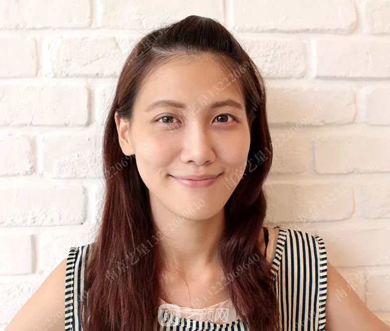 Yestar美杜莎美眼術一周案例圖片，芭比雙眼皮果很好~