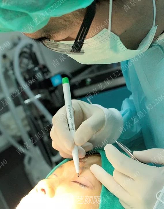 Yestar美杜莎美眼術一周案例圖片，芭比雙眼皮果很好~