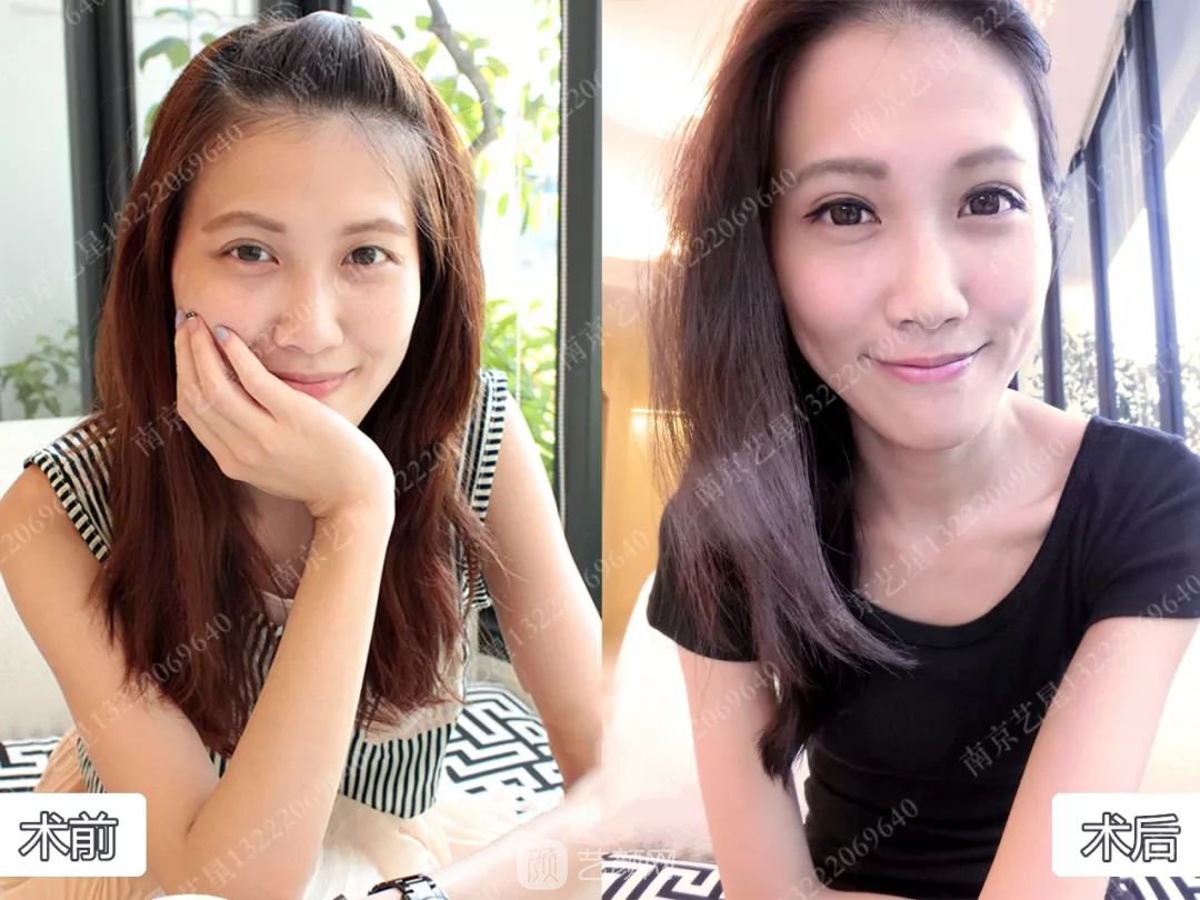 Yestar美杜莎美眼術一周案例圖片，芭比雙眼皮果很好~