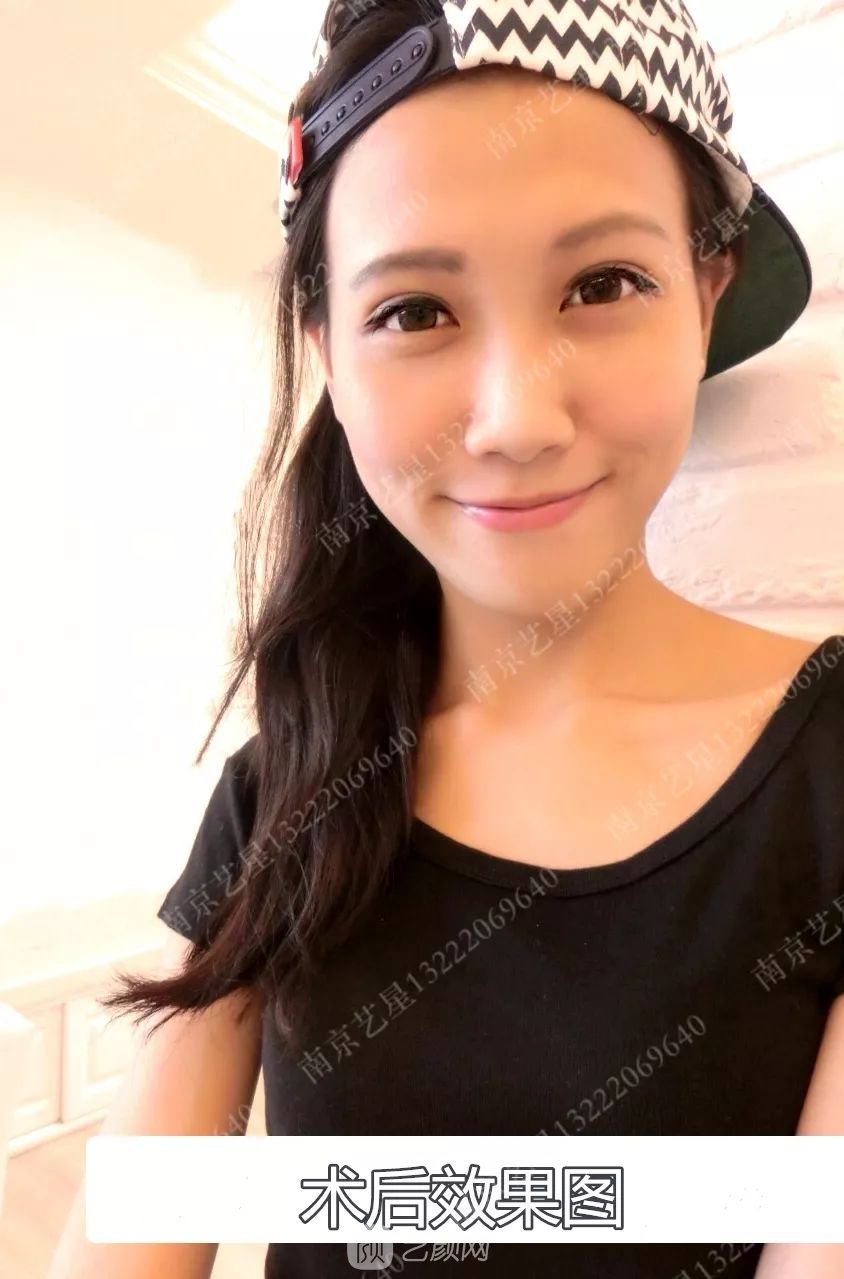 Yestar美杜莎美眼術一周案例圖片，芭比雙眼皮果很好~