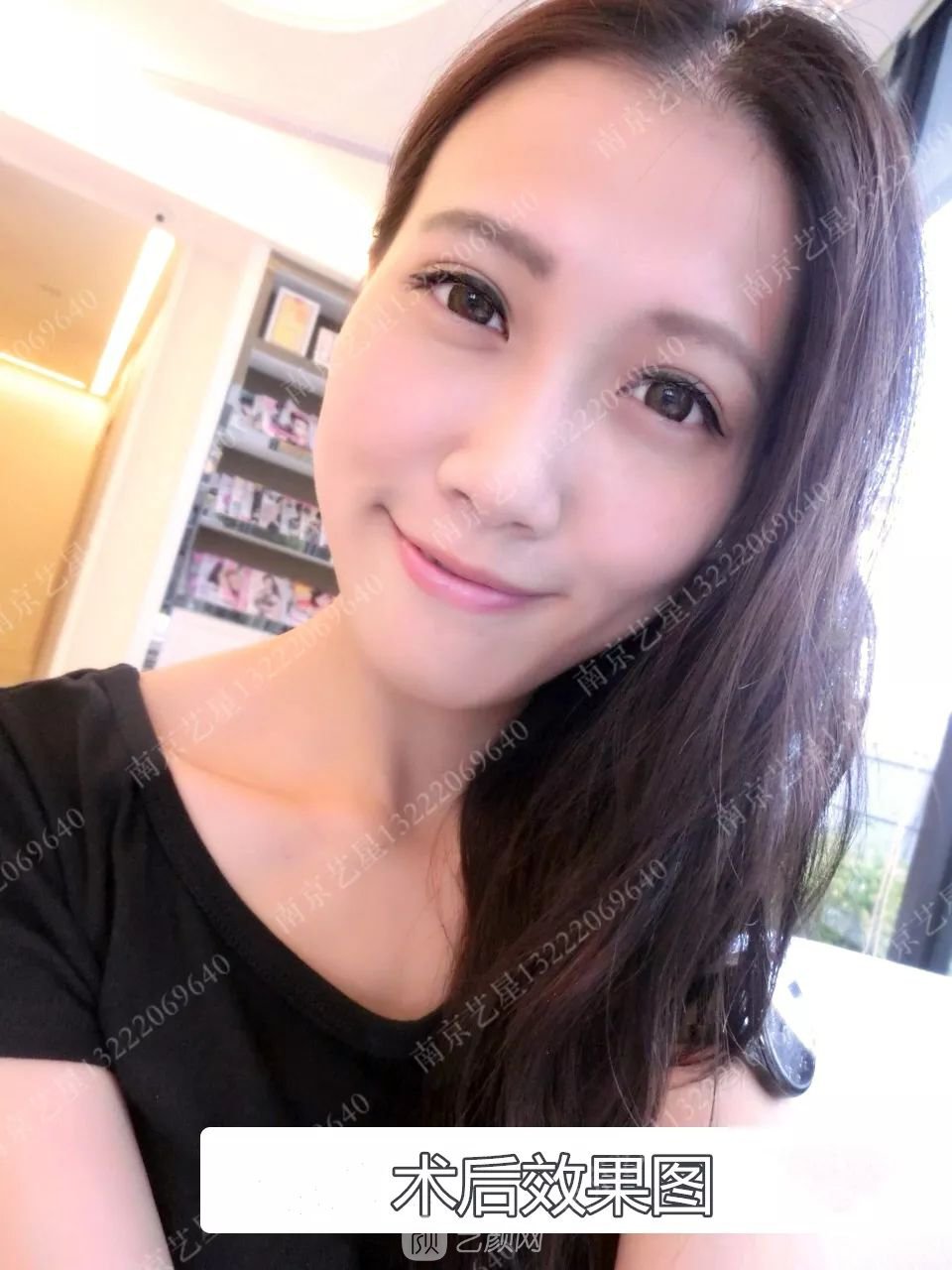 Yestar美杜莎美眼術一周案例圖片，芭比雙眼皮果很好~