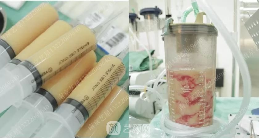 南京藝星自體脂肪豐胸術(shù)一個(gè)月案例分享~