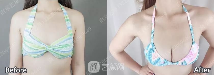 南京藝星自體脂肪豐胸術(shù)一個(gè)月案例分享~