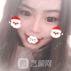 四川隆鼻哪家醫(yī)院好？成都成美馮春雨硅膠隆鼻+假體墊下巴恢復(fù)果圖