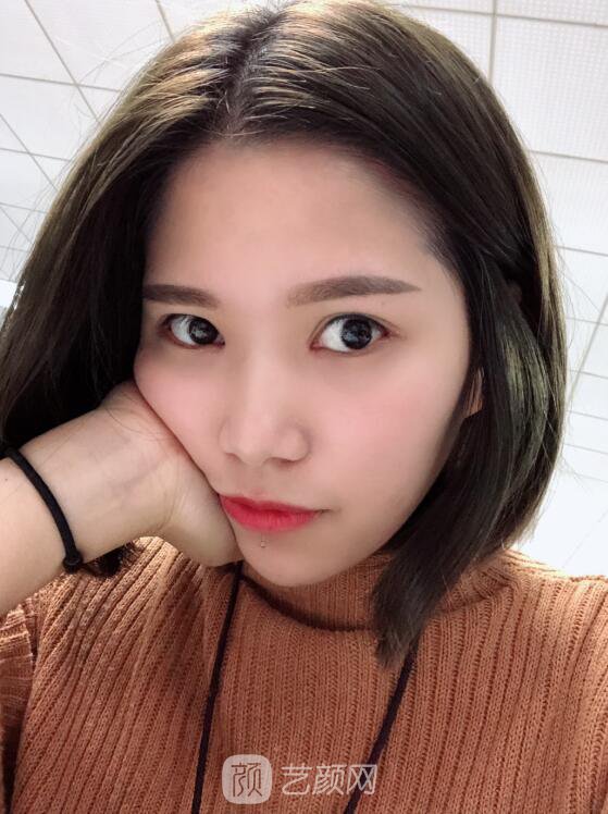 開眼角圖真實(shí)案例分享哦