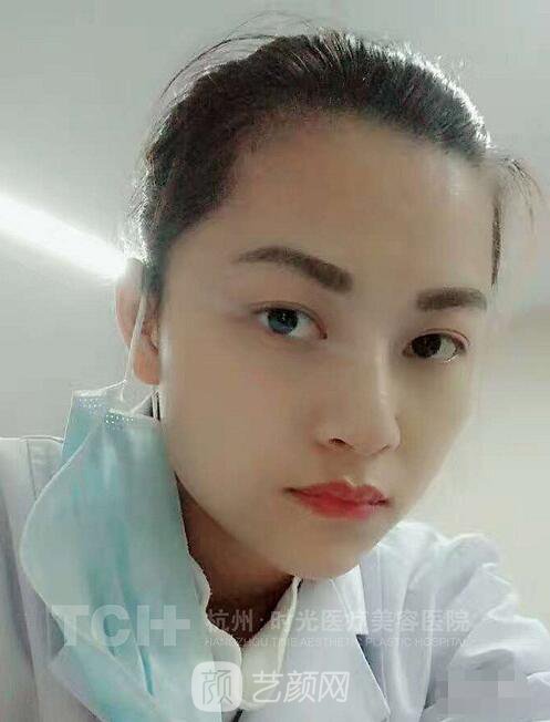 玻尿酸隆鼻案例