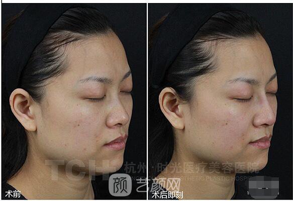 玻尿酸隆鼻案例