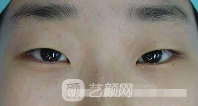 張嬌嬌醫(yī)生做的小切口雙眼皮手術案例