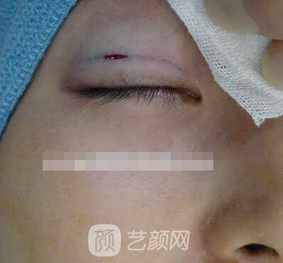張嬌嬌醫(yī)生做的小切口雙眼皮手術案例