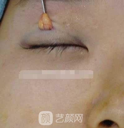 張嬌嬌醫(yī)生做的小切口雙眼皮手術案例
