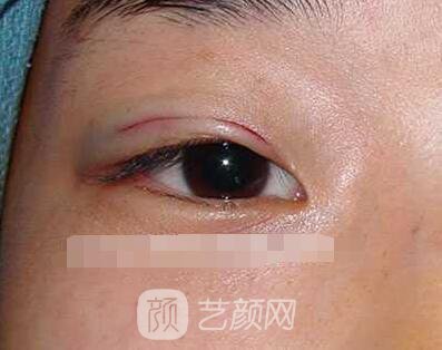 張嬌嬌醫(yī)生做的小切口雙眼皮手術案例