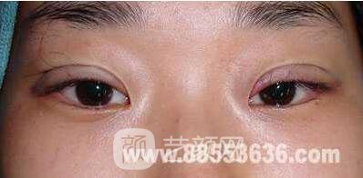 張嬌嬌醫(yī)生做的小切口雙眼皮手術案例