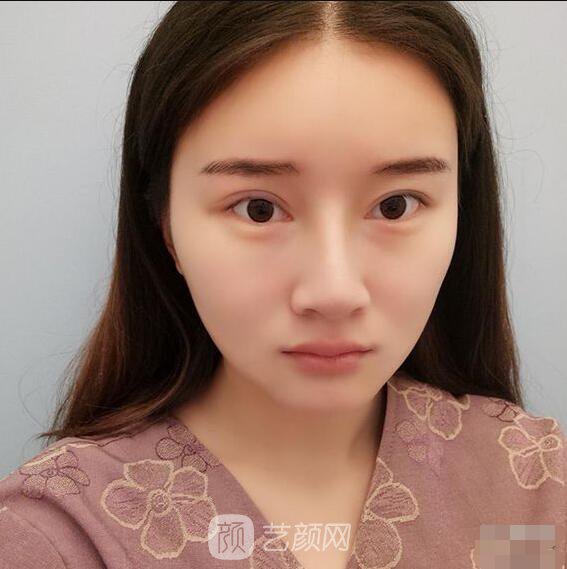 顴骨內(nèi)推真實案例，小臉網(wǎng)紅模板臉型