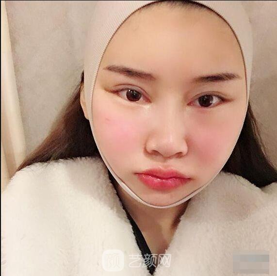 顴骨內(nèi)推真實案例，小臉網(wǎng)紅模板臉型