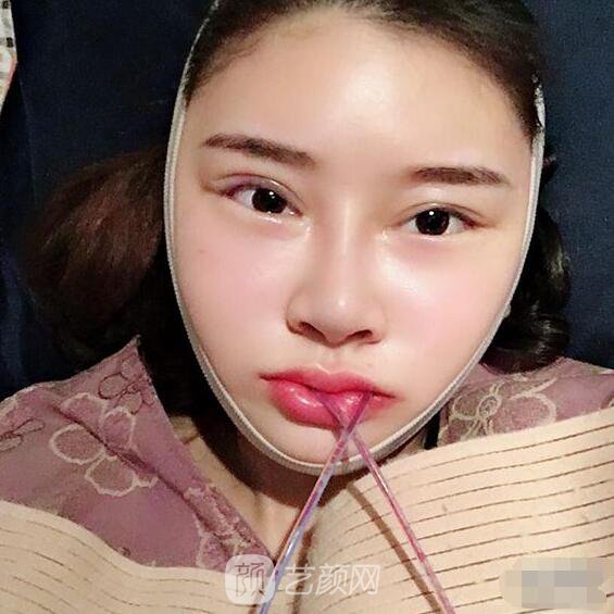 顴骨內(nèi)推真實案例，小臉網(wǎng)紅模板臉型