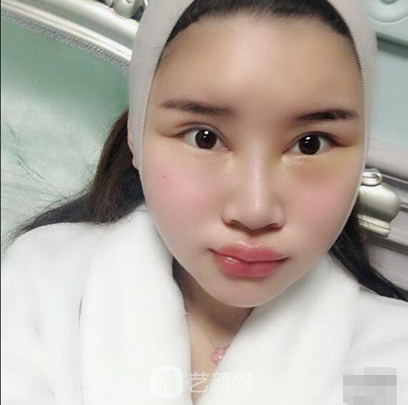 顴骨內(nèi)推真實案例，小臉網(wǎng)紅模板臉型