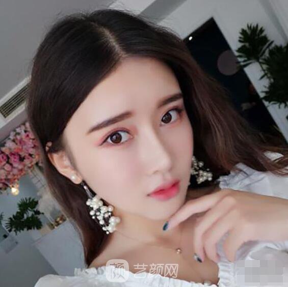 顴骨內(nèi)推真實案例，小臉網(wǎng)紅模板臉型