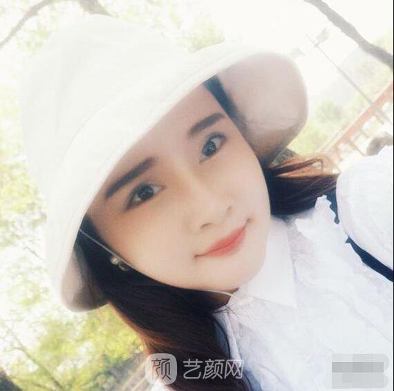 顴骨內(nèi)推真實案例，小臉網(wǎng)紅模板臉型