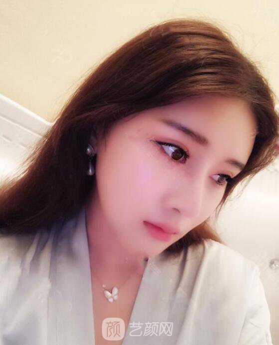 顴骨內(nèi)推真實案例，小臉網(wǎng)紅模板臉型