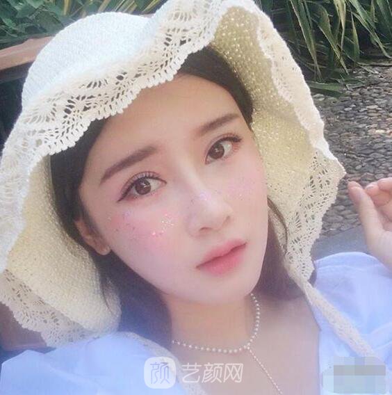 顴骨內(nèi)推真實案例，小臉網(wǎng)紅模板臉型