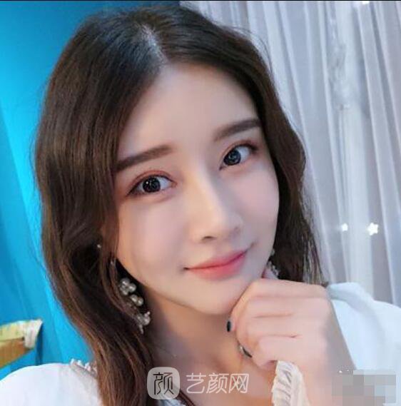 顴骨內(nèi)推真實案例，小臉網(wǎng)紅模板臉型