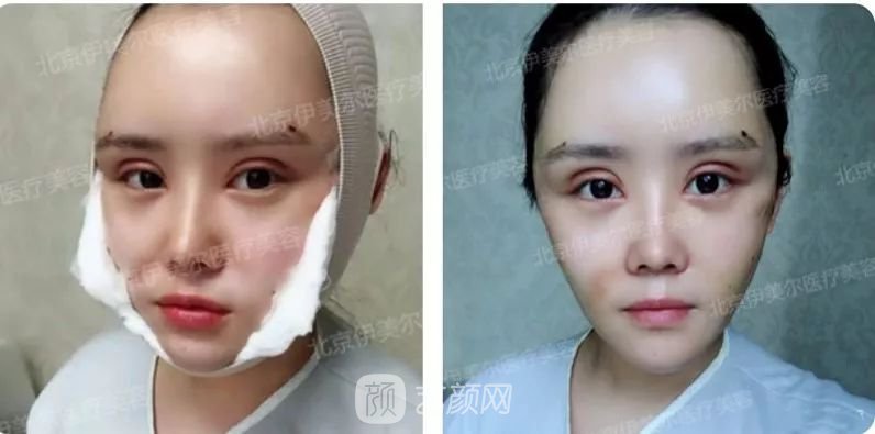 伊美爾幸福李輝靈動面部年輕化術(shù)后兩個月恢復(fù)日記~