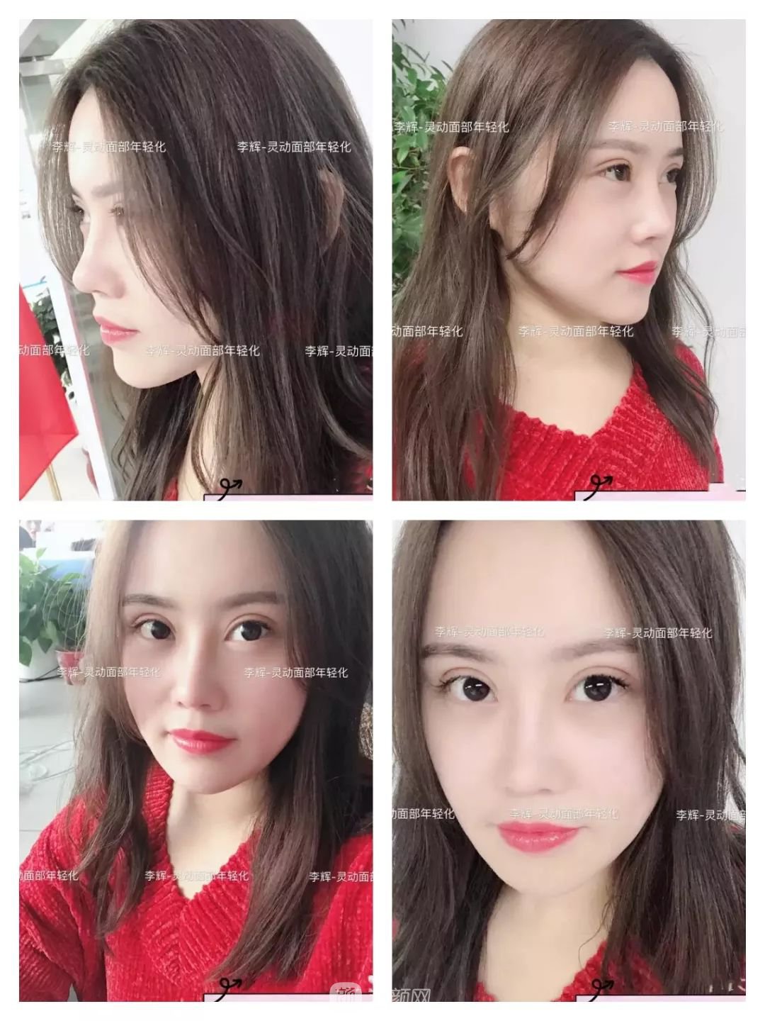 伊美爾幸福李輝靈動面部年輕化術(shù)后兩個月恢復(fù)日記~